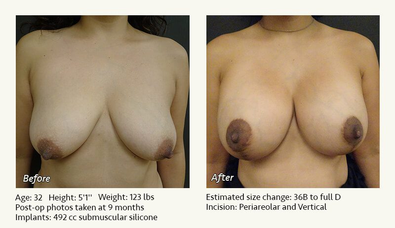 Breast Lift in Plano & Dallas, TX - Patient 26