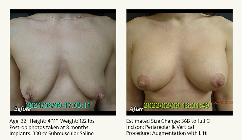 Breast Lift in Plano & Dallas, TX - Patient 15