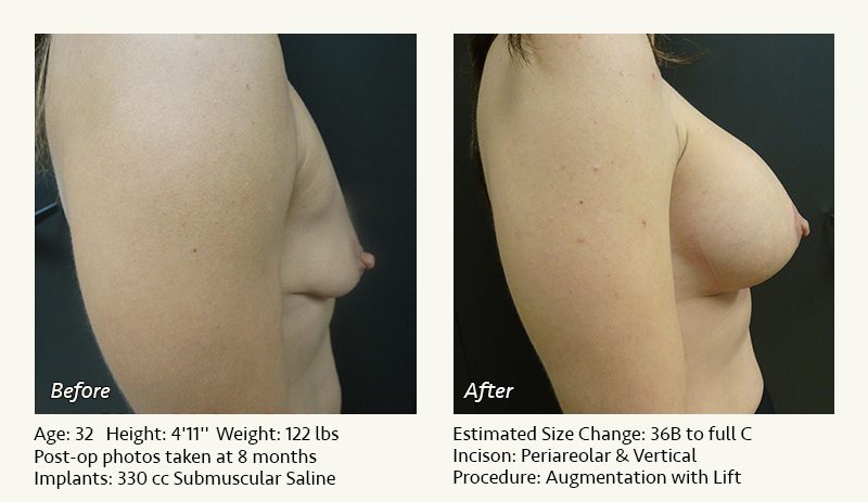 Breast Lift in Plano & Dallas, TX - Patient 16