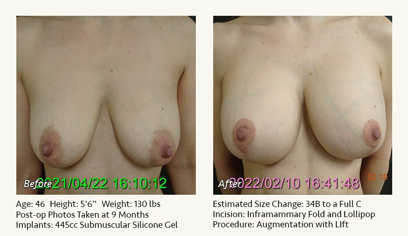Breast Lift in Plano & Dallas, TX - Patient 13