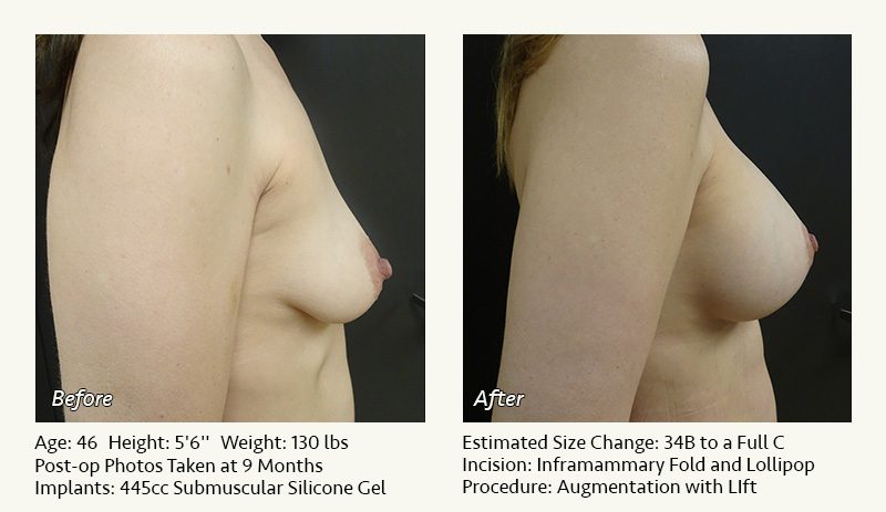 Breast Lift in Plano & Dallas, TX - Patient 14
