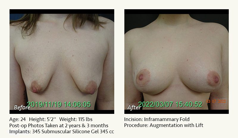 Breast Lift in Plano & Dallas, TX - Patient 11