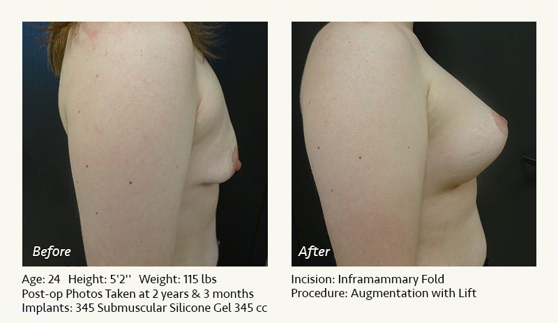Breast Lift in Plano & Dallas, TX - Patient 12