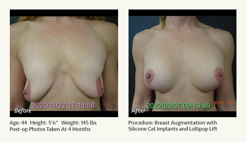 Breast Lift in Plano & Dallas, TX - Patient 9