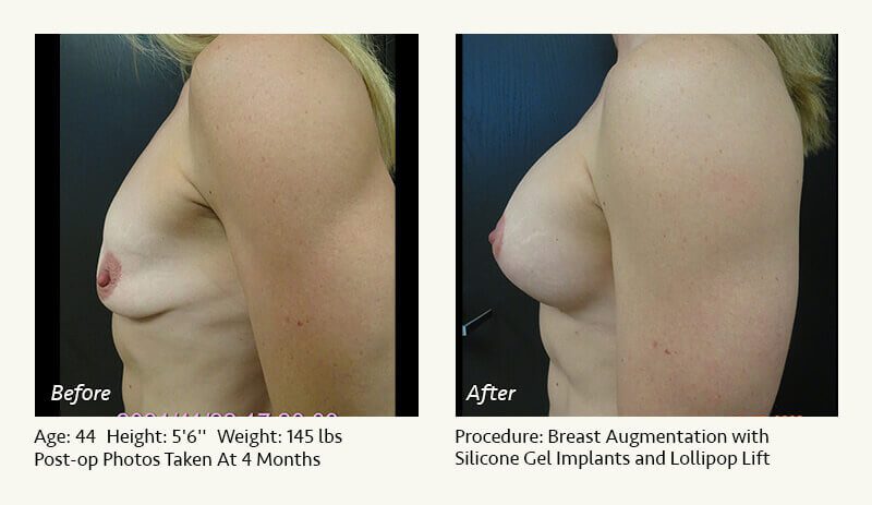 Breast Lift in Plano & Dallas, TX - Patient 10