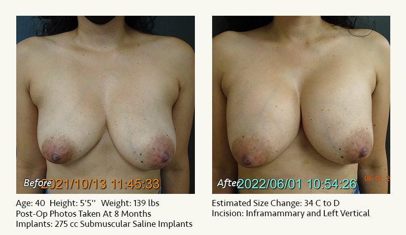Breast Lift in Plano & Dallas, TX - Patient 7