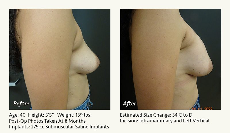 Breast Lift in Plano & Dallas, TX - Patient 8
