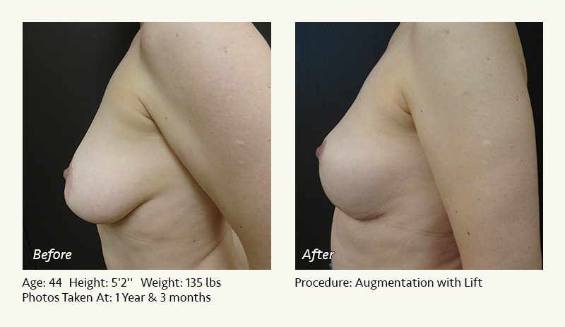Breast Lift in Plano & Dallas, TX - Patient 6
