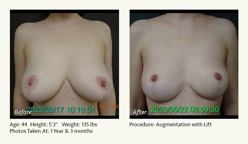 Breast Lift in Plano & Dallas, TX - Patient 5