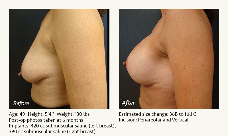 Breast Lift in Plano & Dallas, TX - Patient 39