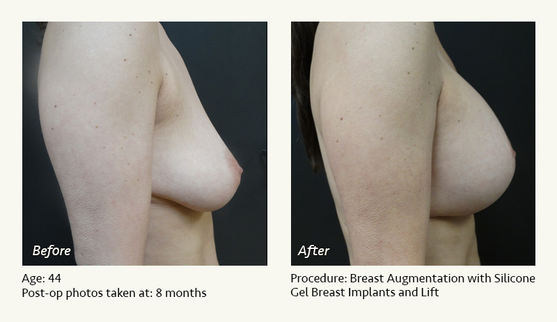 Breast Augmentation With Lift in Plano, TX - Patient 2