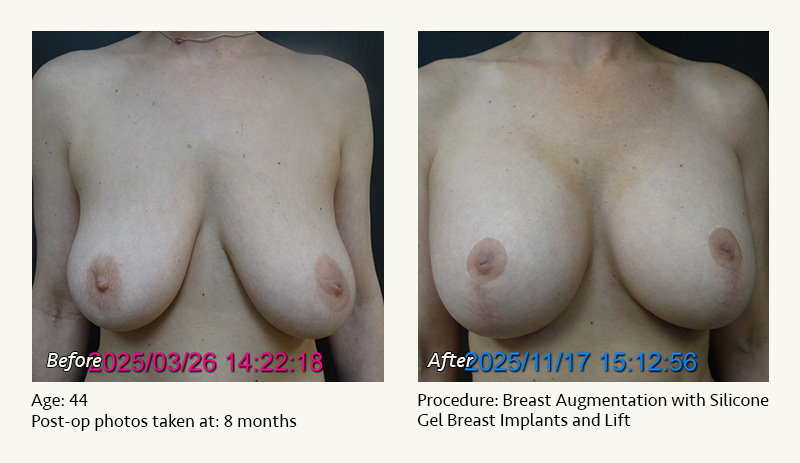Breast Augmentation With Lift in Plano, TX - Patient 1