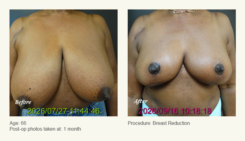 Breast Reduction (Female) in Plano, TX - Patient 1