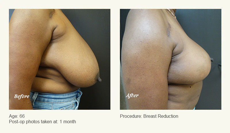 Breast Reduction (Female) in Plano, TX - Patient 2