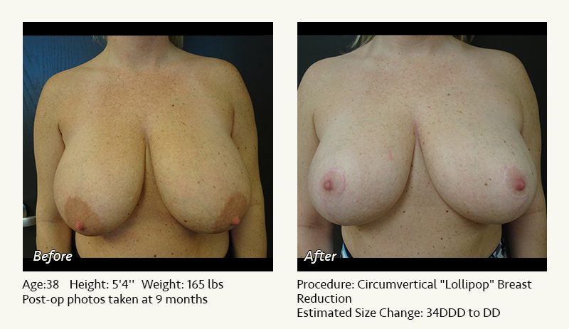 Breast Reduction (Female) in Plano, TX - Patient 37