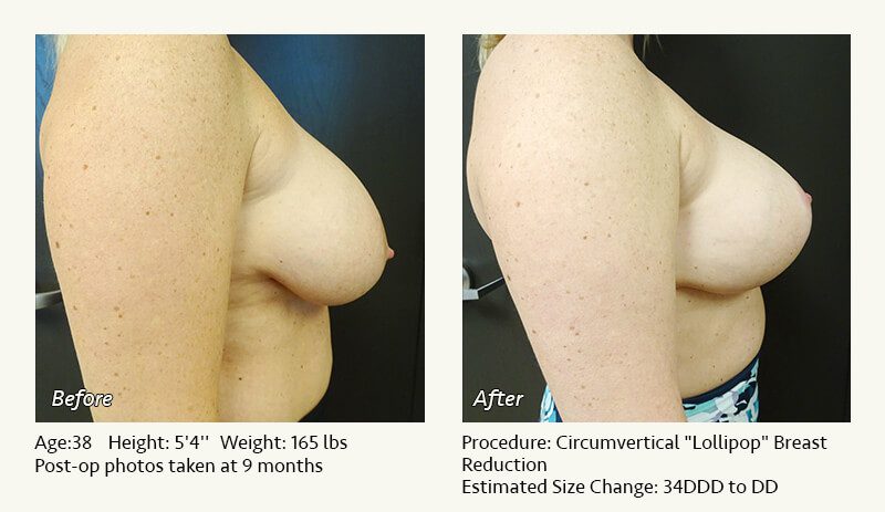 Breast Reduction (Female) in Plano, TX - Patient 38