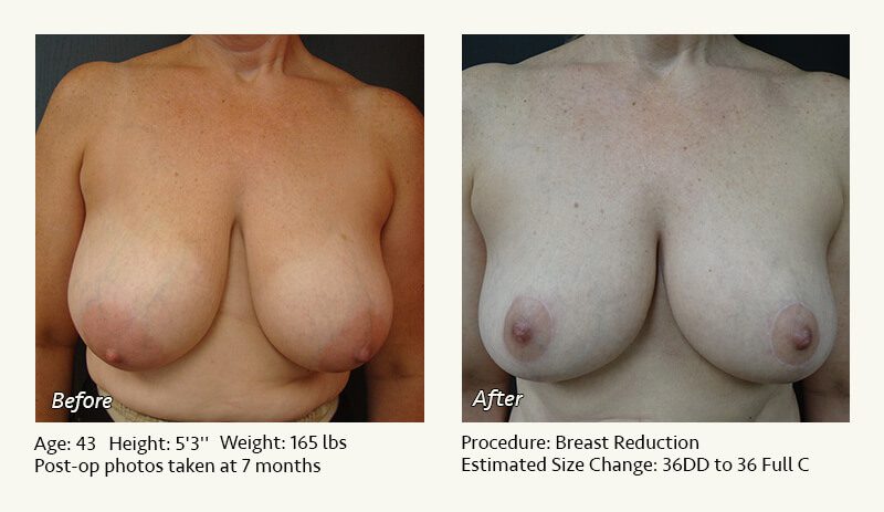 Breast Reduction (Female) in Plano, TX - Patient 39