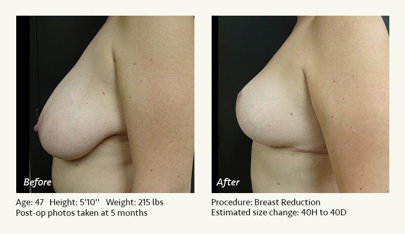 Breast Reduction (Female) in Plano, TX - Patient 36