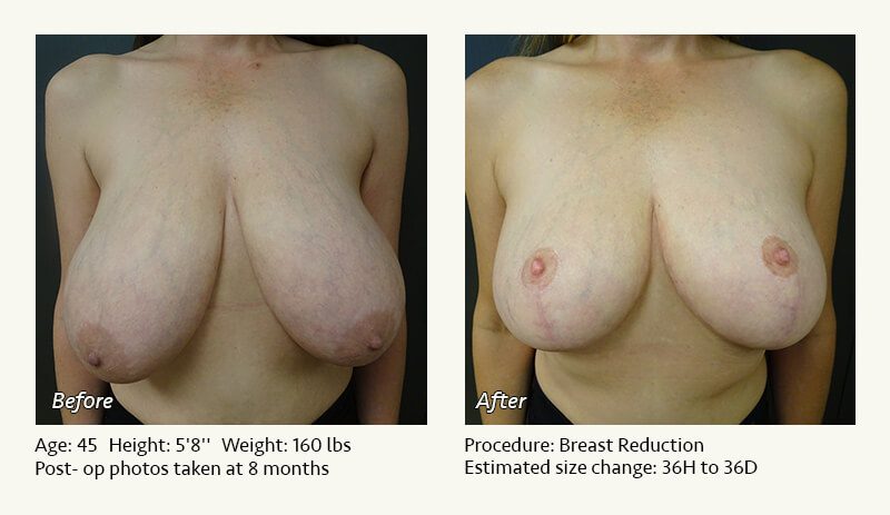 Breast Reduction (Female) in Plano, TX - Patient 33