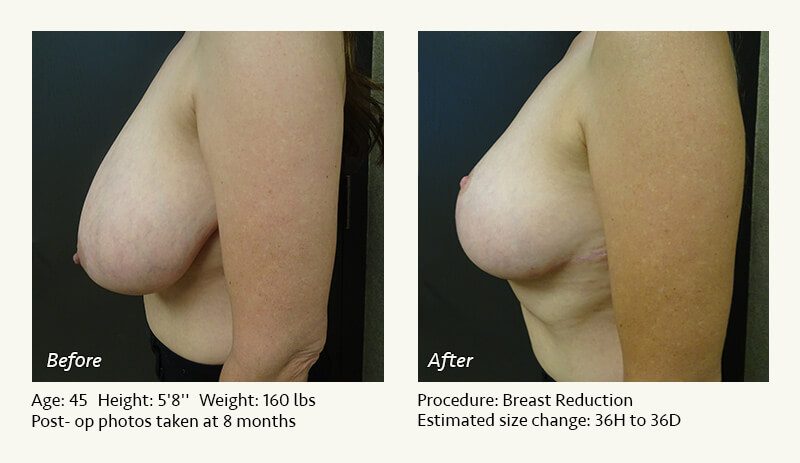 Breast Reduction (Female) in Plano, TX - Patient 34