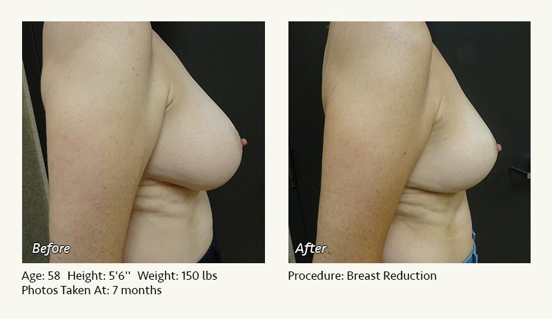 Breast Reduction (Female) in Plano, TX - Patient 26