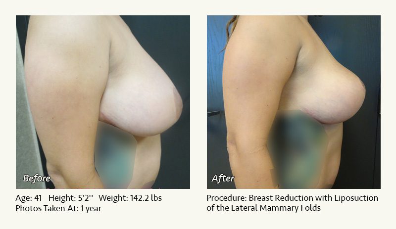 Breast Reduction (Female) in Plano, TX - Patient 22