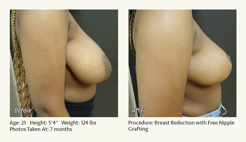 Breast Reduction (Female) in Plano, TX - Patient 20