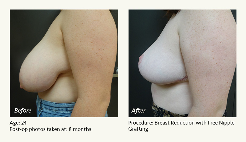 Breast Reduction (Female) in Plano, TX - Patient 2