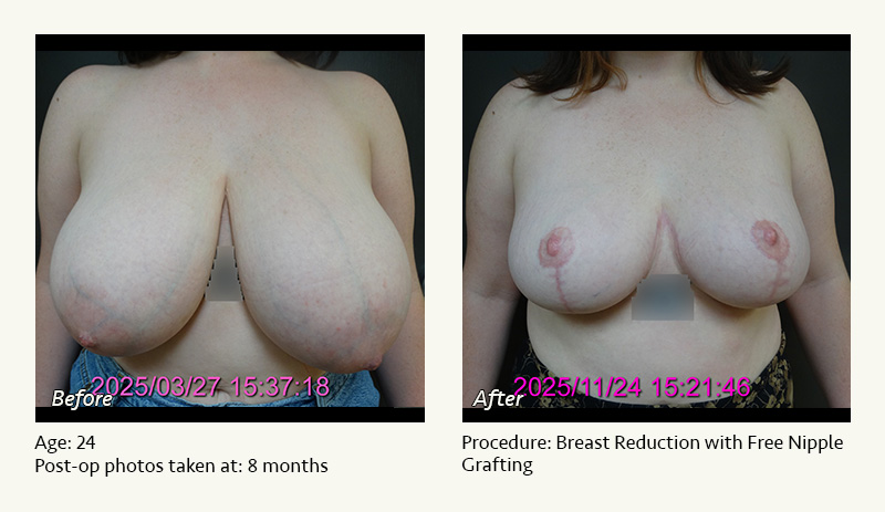 Breast Reduction (Female) in Plano, TX - Patient 1