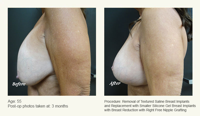 Breast Implant Revision in Plano, TX - Patient 4