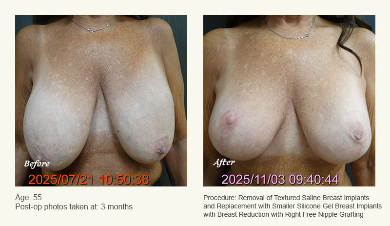 Breast Implant Revision in Plano, TX - Patient 3