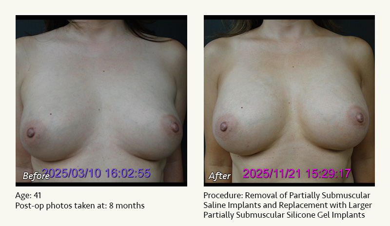 Breast Implant Revision in Plano, TX - Patient 1