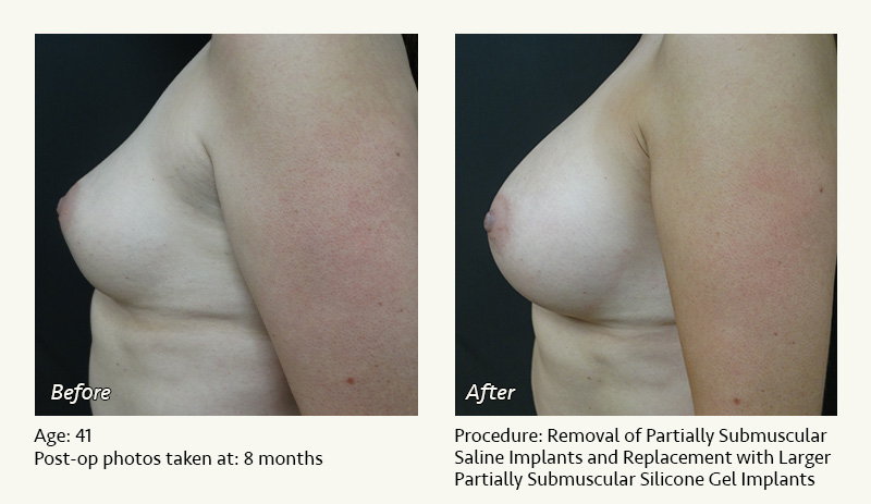 Breast Implant Revision in Plano, TX - Patient 2