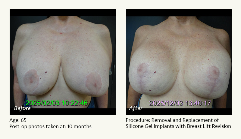 Breast Implant Revision in Plano, TX - Patient 1