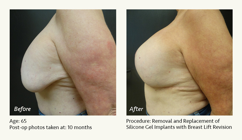 Breast Implant Revision in Plano, TX - Patient 2