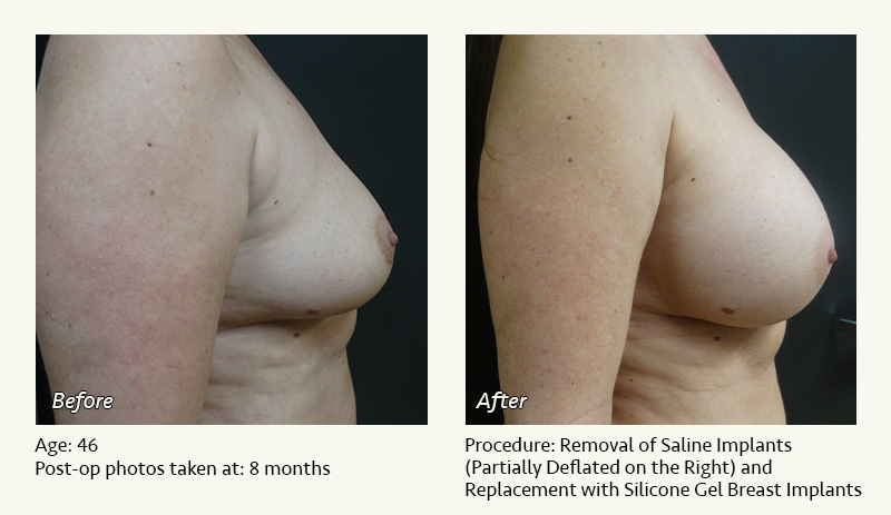 Breast Implant Revision in Plano, TX - Patient 2