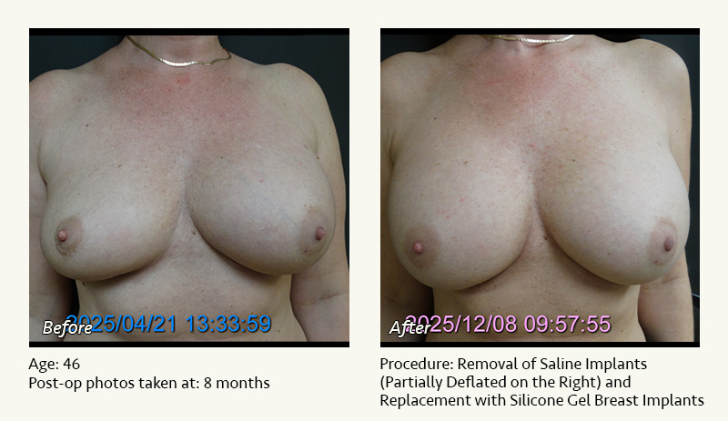 Breast Implant Revision in Plano, TX - Patient 1