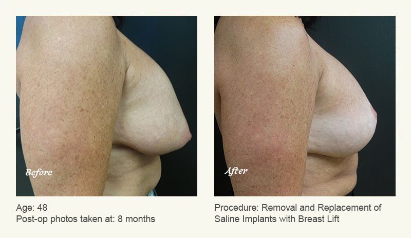 Breast Implant Revision in Plano, TX - Patient 2
