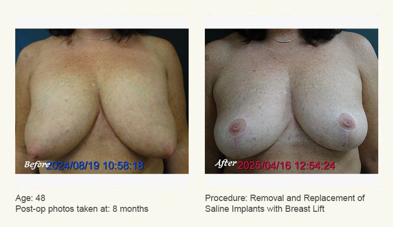 Breast Implant Revision in Plano, TX - Patient 1