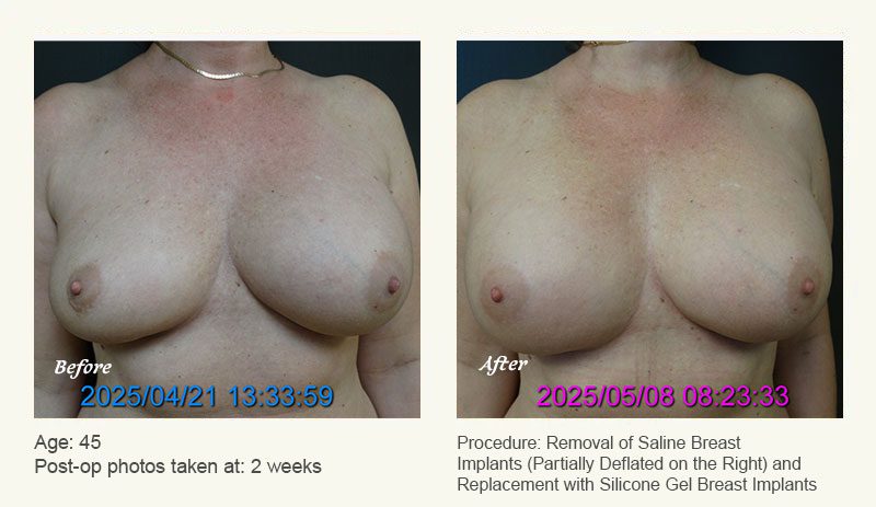 Breast Implant Revision in Plano, TX - Patient 1