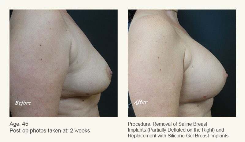 Breast Implant Revision in Plano, TX - Patient 2