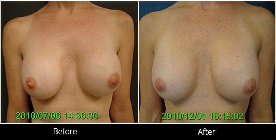 Breast Implant Revision Before & After 4 Front