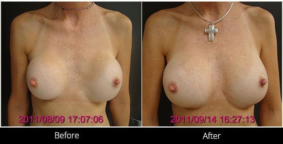 Breast Implant Revision Before & After 5 Front