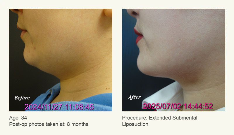 Chin Liposuction in Plano, TX - Patient 2