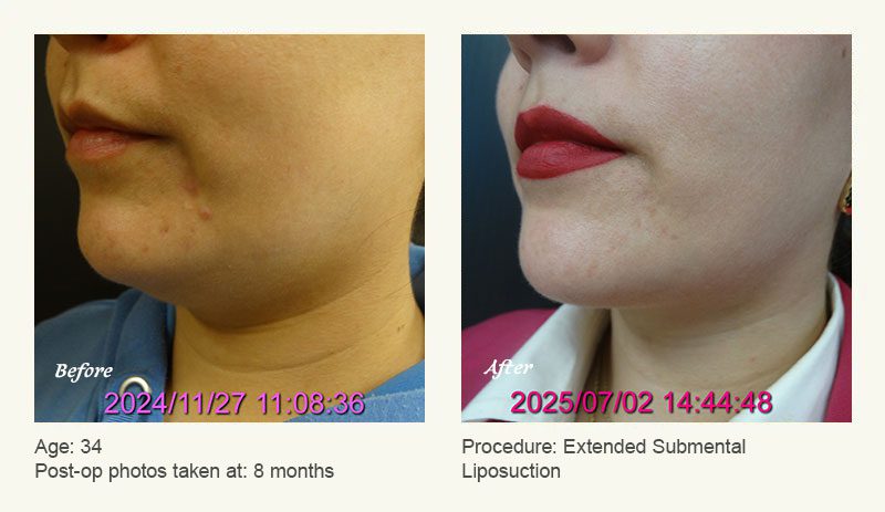 Chin Liposuction in Plano, TX - Patient 1