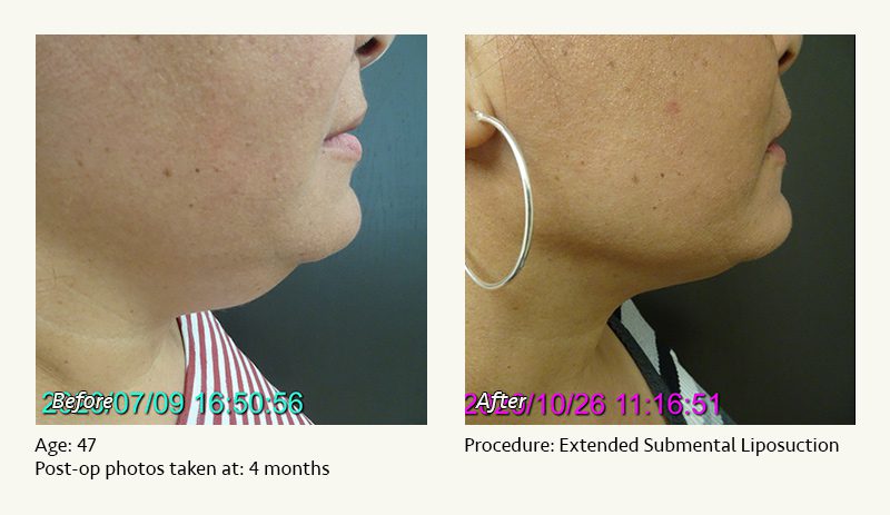 Chin Liposuction in Plano, TX - Patient 34