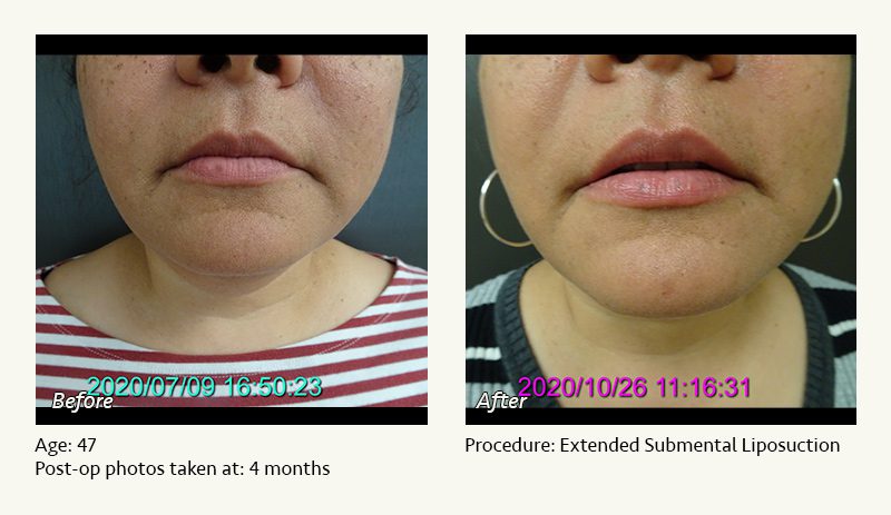 Chin Liposuction in Plano, TX - Patient 33