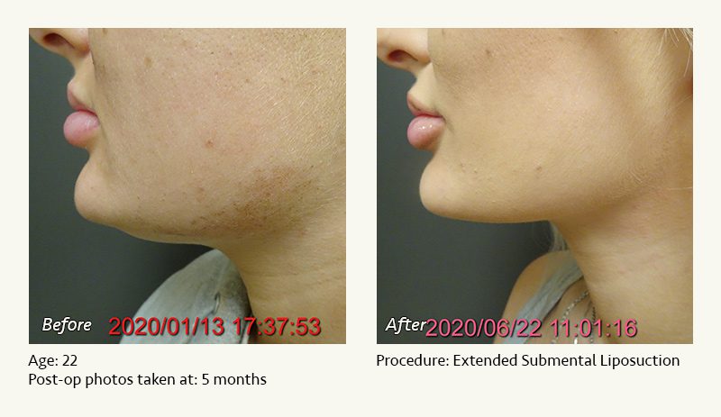 Chin Liposuction in Plano, TX - Patient 32