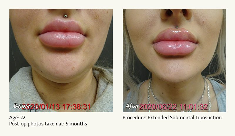 Chin Liposuction in Plano, TX - Patient 31