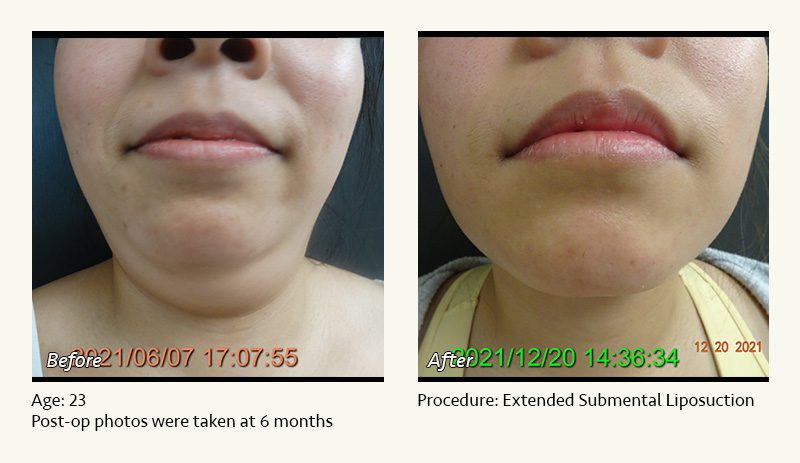 Chin Liposuction in Plano, TX - Patient 29